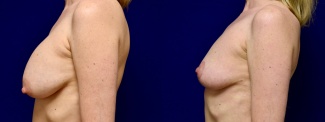 Left Profile View - Breast Implant Removal with Breast Lift