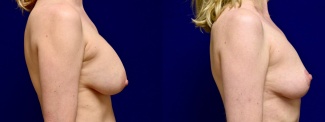 Right Profile View - Breast Implant Removal with Breast Lift
