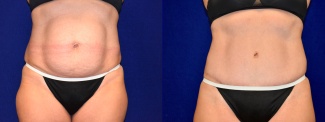 Frontal View - Tummy Tuck