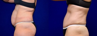 Left Profile View - Tummy Tuck