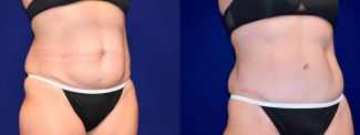 Right 3/4 View - Tummy Tuck