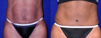 Frontal View - Tummy Tuck