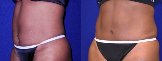 Left 3/4 View - Tummy Tuck