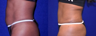 Left Profile View - Tummy Tuck