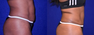 Right Profile View - Tummy Tuck