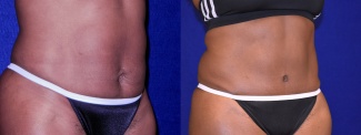 Left 3/4 View - Tummy Tuck