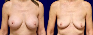 Frontal View - Breast Implant Removal