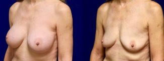 Left 3/4 View - Breast Implant Removal