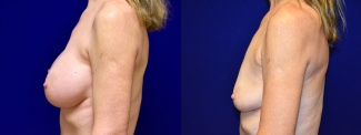 Left Profile View - Breast Implant Removal