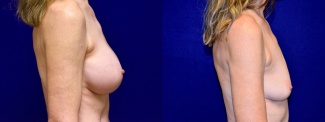 Right Profile View - Breast Implant Removal