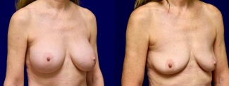 Right 3/4 View - Breast Implant Removal