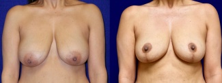 Frontal View - Breast Reduction