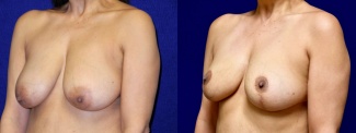 Left 3/4 View - Breast Reduction