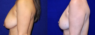 Left Profile View - Breast Reduction