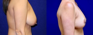 Right Profile View - Breast Reduction