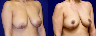 Right 3/4 View - Breast Reduction