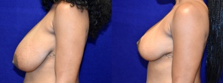 Left Profile View - Breast Reduction