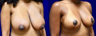 Right 3/4 View - Breast Reduction