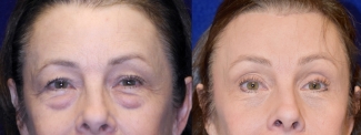 Frontal View - Browlift with Upper and Lower Blepharoplasty