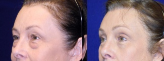 Left 3/4 View - Browlift with Upper and Lower Blepharoplasty