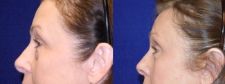 Left Profile View - Browlift with Upper and Lower Blepharoplasty