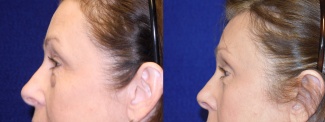 Left Profile View - Browlift with Upper and Lower Blepharoplasty