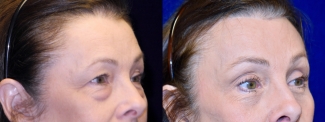 Right 3/4 View - Browlift with Upper and Lower Blepharoplasty