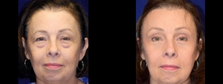 Frontal View Full- Browlift with Upper and Lower Blepharoplasty