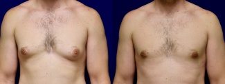 Frontal View - Gynecomastia