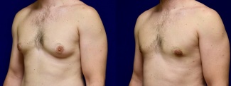 Left 3/4 View - Gynecomastia