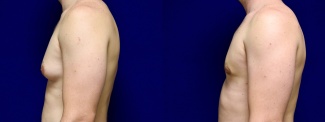 Left Profile View - Gynecomastia