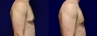 Right Profile View - Gynecomastia