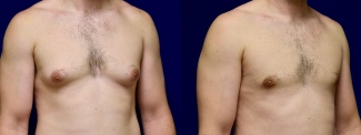 Right 3/4 View - Gynecomastia