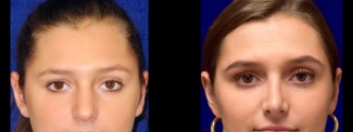 Frontal View - Rhinoplasty