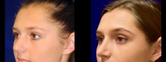 Left 3/4 View - Rhinoplasty