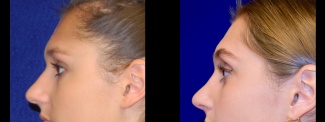 Left Profile View - Rhinoplasty