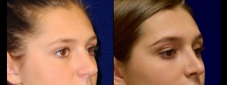 Right 3/4 View - Rhinoplasty