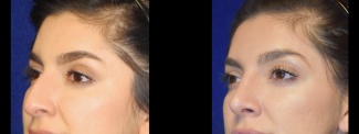 Left 3/4 View - Rhinoplasty