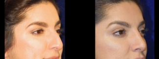 Right 3/4 View - Rhinoplasty