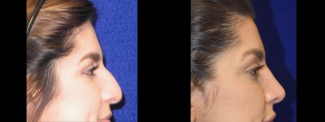 Right Profile View - Rhinoplasty