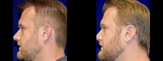 Left Profile View - Otoplasty