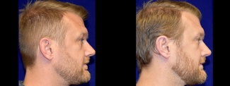 Right Profile View - Otoplasty