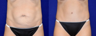 Frontal View - Tummy Tuck