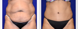 Frontal View - Tummy Tuck