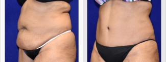 Left 3/4 View - Tummy Tuck