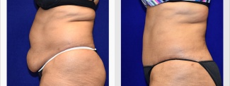 Left Profile View - Tummy Tuck