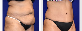 Right 3/4 View - Tummy Tuck