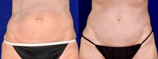 Frontal View - Limited Incision Tummy Tuck