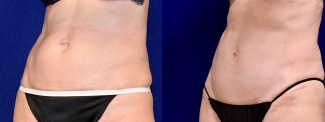 Left 3/4 View - Limited Incision Tummy Tuck