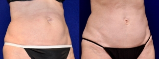 Right 3/4 View - Limited Incision Tummy Tuck